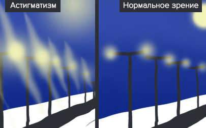 Можно ли заниматься боксом при астигматизме? Каковы риски?